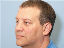 Rhinoplasty Before Photo by Paul Vanek, MD, FACS; Concord, OH - Case 32713
