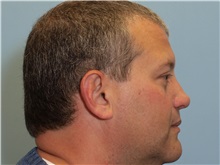 Rhinoplasty After Photo by Paul Vanek, MD, FACS; Concord, OH - Case 32713