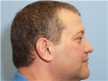 Rhinoplasty Before Photo by Paul Vanek, MD, FACS; Concord, OH - Case 32713