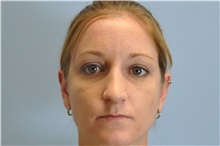 Rhinoplasty After Photo by Paul Vanek, MD, FACS; Concord, OH - Case 32715