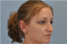 Rhinoplasty Before Photo by Paul Vanek, MD, FACS; Concord, OH - Case 32715