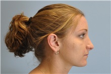Rhinoplasty After Photo by Paul Vanek, MD, FACS; Concord, OH - Case 32715