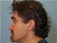 Rhinoplasty After Photo by Paul Vanek, MD, FACS; Concord, OH - Case 32716
