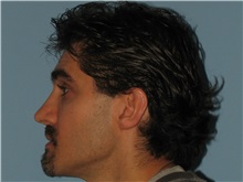 Rhinoplasty Before Photo by Paul Vanek, MD, FACS; Concord, OH - Case 32716