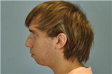 Chin Augmentation Before Photo by Paul Vanek, MD, FACS; Concord, OH - Case 32717