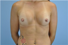 Breast Augmentation After Photo by Paul Vanek, MD, FACS; Concord, OH - Case 32753
