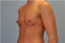 Breast Augmentation Before Photo by Paul Vanek, MD, FACS; Concord, OH - Case 32753