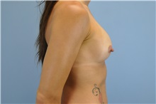Breast Augmentation After Photo by Paul Vanek, MD, FACS; Concord, OH - Case 32753