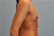 Breast Augmentation Before Photo by Paul Vanek, MD, FACS; Concord, OH - Case 32753