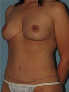 Body Contouring After Photo by Paul Vanek, MD, FACS; Concord, OH - Case 32755