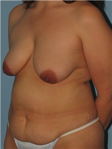 Body Contouring Before Photo by Paul Vanek, MD, FACS; Concord, OH - Case 32755