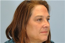 Eyelid Surgery After Photo by Paul Vanek, MD, FACS; Concord, OH - Case 32757