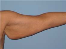 Arm Lift Before Photo by Paul Vanek, MD, FACS; Concord, OH - Case 32759