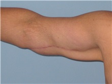 Arm Lift After Photo by Paul Vanek, MD, FACS; Concord, OH - Case 32759