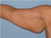 Arm Lift Before Photo by Paul Vanek, MD, FACS; Concord, OH - Case 32759