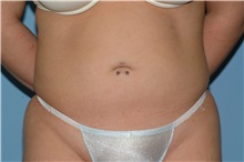 Tummy Tuck After Photo by Paul Vanek, MD, FACS; Concord, OH - Case 32762