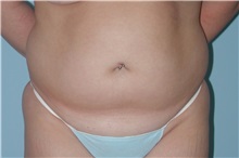Tummy Tuck Before Photo by Paul Vanek, MD, FACS; Concord, OH - Case 32762