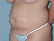 Tummy Tuck Before Photo by Paul Vanek, MD, FACS; Concord, OH - Case 32762
