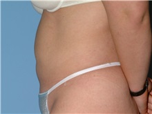 Tummy Tuck After Photo by Paul Vanek, MD, FACS; Concord, OH - Case 32762