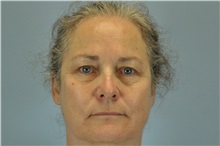 Eyelid Surgery Before Photo by Paul Vanek, MD, FACS; Concord, OH - Case 32763