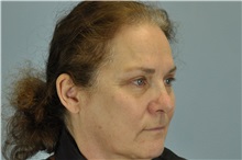 Eyelid Surgery After Photo by Paul Vanek, MD, FACS; Concord, OH - Case 32763