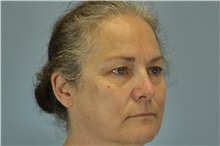 Eyelid Surgery Before Photo by Paul Vanek, MD, FACS; Concord, OH - Case 32763