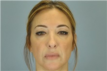 Eyelid Surgery Before Photo by Paul Vanek, MD, FACS; Concord, OH - Case 32764