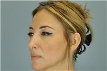 Eyelid Surgery Before Photo by Paul Vanek, MD, FACS; Concord, OH - Case 32764