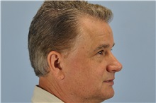 Eyelid Surgery Before Photo by Paul Vanek, MD, FACS; Concord, OH - Case 32766