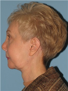 Chin Augmentation After Photo by Paul Vanek, MD, FACS; Concord, OH - Case 32772