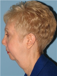 Chin Augmentation Before Photo by Paul Vanek, MD, FACS; Concord, OH - Case 32772