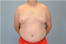Male Breast Reduction After Photo by Paul Vanek, MD, FACS; Concord, OH - Case 32773