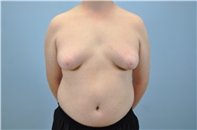 Male Breast Reduction Before Photo by Paul Vanek, MD, FACS; Concord, OH - Case 32773