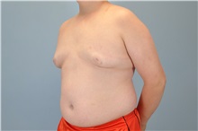 Male Breast Reduction After Photo by Paul Vanek, MD, FACS; Concord, OH - Case 32773