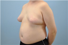 Male Breast Reduction Before Photo by Paul Vanek, MD, FACS; Concord, OH - Case 32773