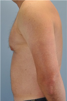 Male Breast Reduction After Photo by Paul Vanek, MD, FACS; Concord, OH - Case 32774