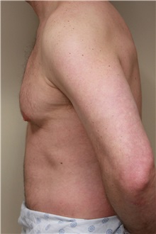 Male Breast Reduction Before Photo by Paul Vanek, MD, FACS; Concord, OH - Case 32774