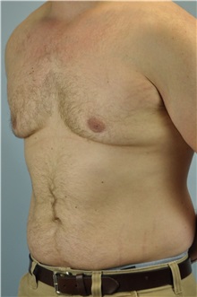 Male Breast Reduction After Photo by Paul Vanek, MD, FACS; Concord, OH - Case 32776