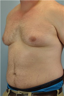 Male Breast Reduction Before Photo by Paul Vanek, MD, FACS; Concord, OH - Case 32776