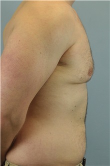 Male Breast Reduction After Photo by Paul Vanek, MD, FACS; Concord, OH - Case 32776