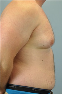 Male Breast Reduction Before Photo by Paul Vanek, MD, FACS; Concord, OH - Case 32776