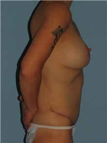 Body Contouring After Photo by Paul Vanek, MD, FACS; Concord, OH - Case 32778