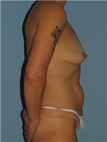 Body Contouring Before Photo by Paul Vanek, MD, FACS; Concord, OH - Case 32778