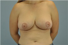 Breast Lift After Photo by Paul Vanek, MD, FACS; Concord, OH - Case 32783