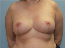 Breast Reduction After Photo by Paul Vanek, MD, FACS; Concord, OH - Case 32784