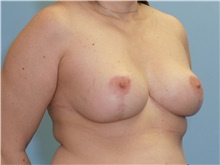 Breast Reduction After Photo by Paul Vanek, MD, FACS; Concord, OH - Case 32784