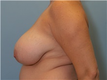 Breast Reduction Before Photo by Paul Vanek, MD, FACS; Concord, OH - Case 32784