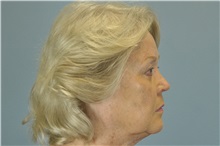 Eyelid Ptosis Repair After Photo by Paul Vanek, MD, FACS; Concord, OH - Case 32786