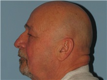 Eyelid Ptosis Repair Before Photo by Paul Vanek, MD, FACS; Concord, OH - Case 32787