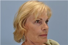 Facelift After Photo by Paul Vanek, MD, FACS; Concord, OH - Case 32788